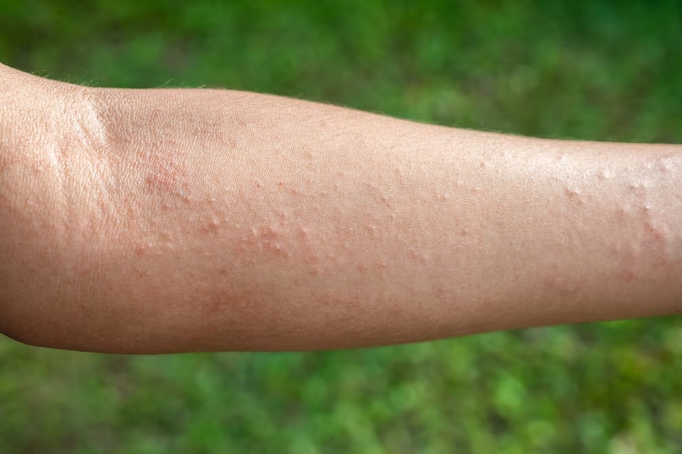 Dull Razor Shaving Rash Razor bumps: Preventing and treating irritations – Belle Body